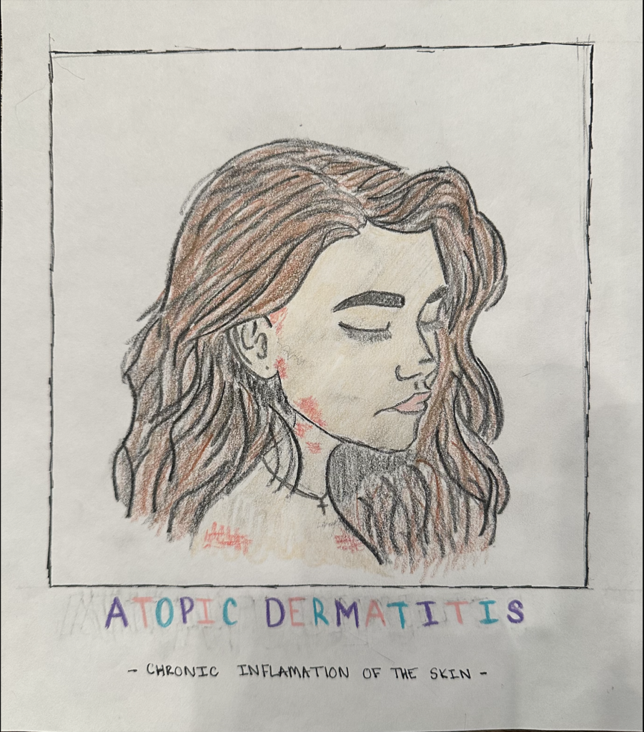 This is a sketch of a woman that suffers from atopic dermatitis. 
Atopic dermatitis is a chronic inflammatory condition of the skin. This condition presents itself as red, dry, itchy patches that appear on the skin. While there is no cure for atopic dermatitis, there are some medications that can help individuals manage their symptoms such as topical steriods, injections, and other oral medications. 